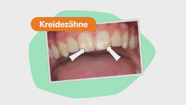Zähne wie aus Kreide?!