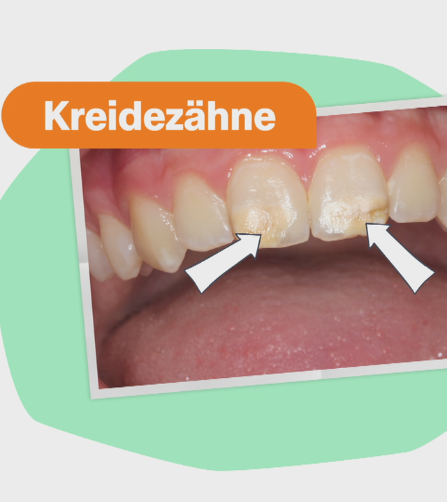 241113_es_kreidezahn_thumb