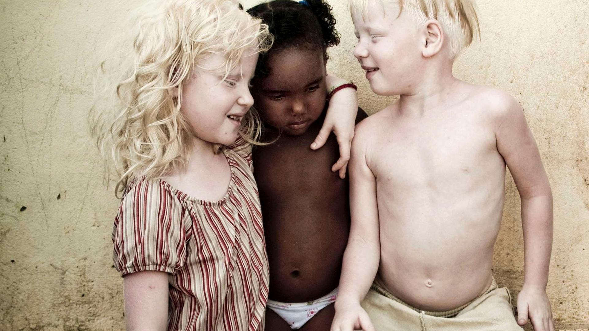 Albino-Geschwister mit dunkelhäutigem Cousin