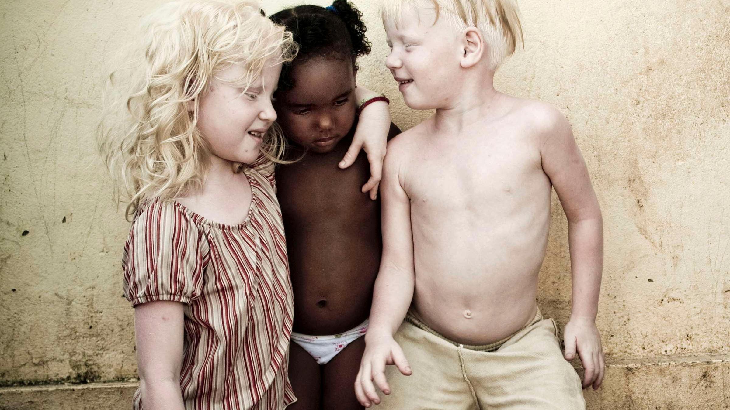 Albino-Geschwister mit dunkelhäutigem Cousin