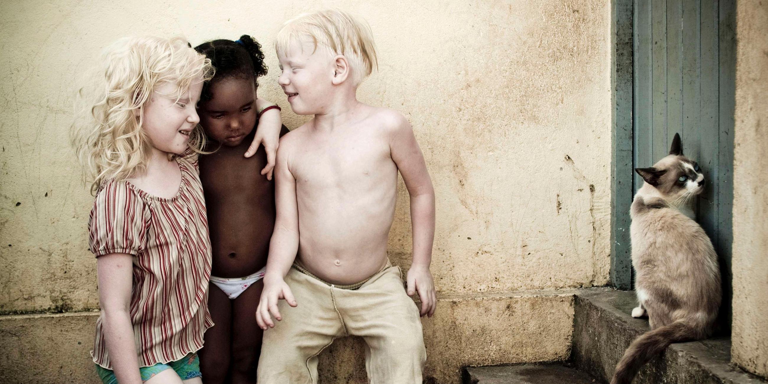 Albino-Geschwister mit dunkelhäutigem Cousin