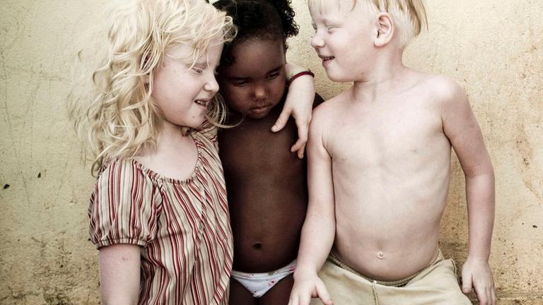 Albino-Geschwister mit dunkelhäutigem Cousin
