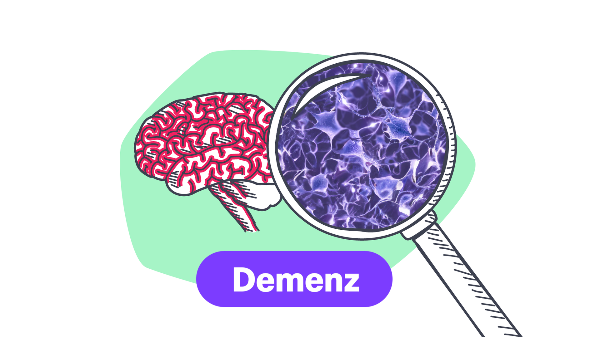 Alzheimer einfach erklärt