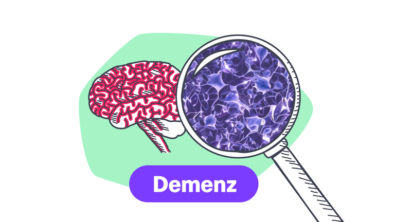 Alzheimer einfach erklärt