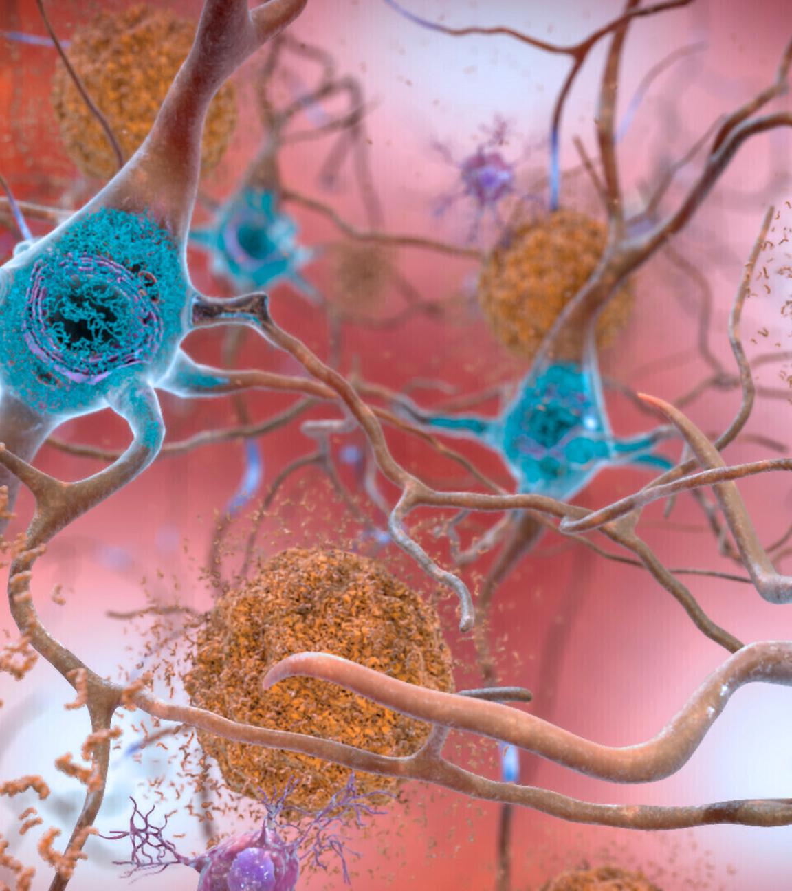 Illustration von Nervenzellen eines Gehirns mit Alzheimer