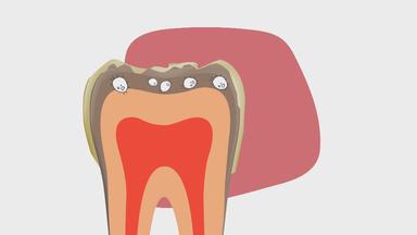 Ein Zahn mit Plaque wird von Bakterien angegriffen, es bildet sich Karies.